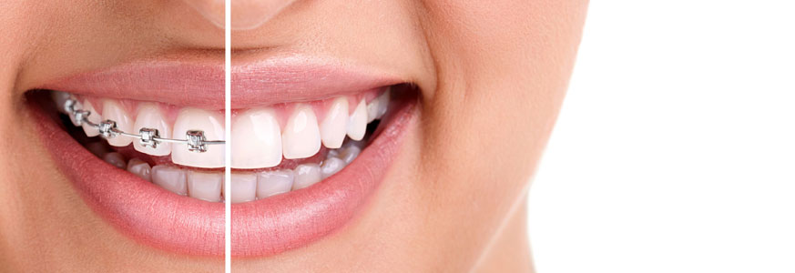 Invisalign Clear Braces, Ottawa University Dentist